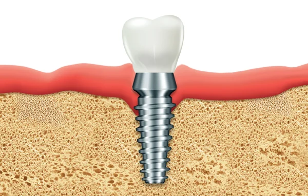 Dental Implant